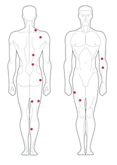 Trigger points